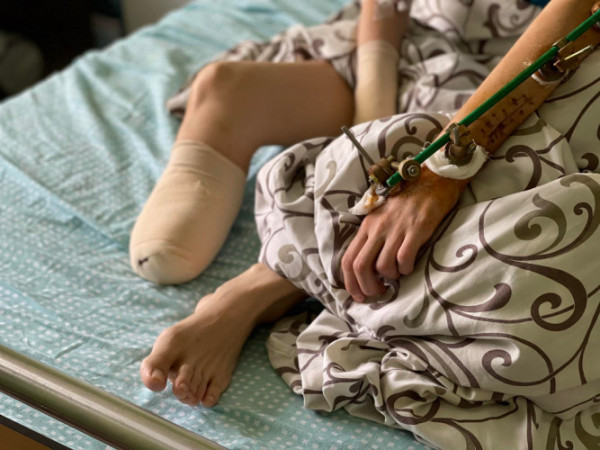 Втратила руку, ногу та дитину під серцем: лікарі дивом врятували жінку з Донеччини