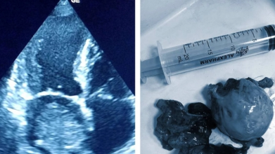 На Рівненщині медики видалили жінці пухлину на серці
